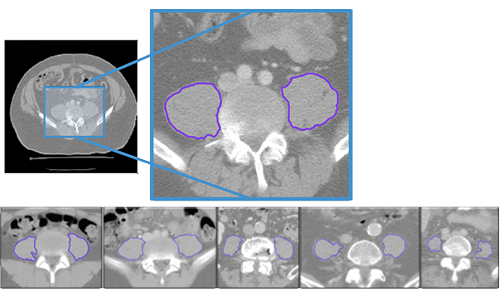 Muscle (psoas)